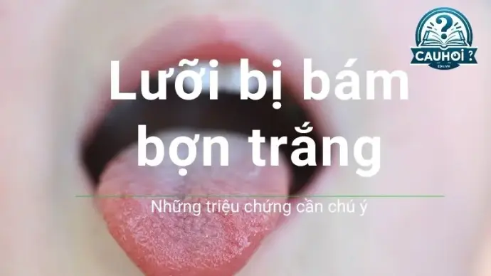 Tại sao lưỡi đóng bợn trắng? Những triệu chứng cần chú ý 