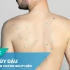 Bị thủy đậu như thế nào? Nguyên nhân, triệu chứng và cách xử lý hiệu quả