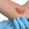 Cách Làm Tan Cục Máu Đông Dưới Da An Toàn Tại Nhà