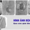 Cục Trĩ Như Thế Nào? Nhận Biết Dấu Hiệu và Cách Xử Lý Hiệu Quả Năm 2026