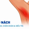 Hạch sữa ở nách: Nguyên nhân, cách làm tan và phòng ngừa hiệu quả