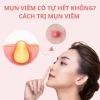 Mụn viêm là gì? Nguyên nhân, dấu hiệu và cách xử lý hiệu quả