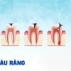 Răng Sâu Độ 3 Là Như Thế Nào? Dấu Hiệu, Tác Hại Và Cách Điều Trị