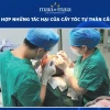 Tác hại của cấy tóc tự thân những điều cần biết