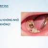 Tác hại khôn lường khi không nhổ răng sâu