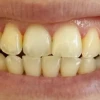 Tại sao đánh răng thường xuyên mà răng vẫn vàng?