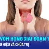 Ung thư vòm họng có biểu hiện như thế nào? Nhận biết sớm để tăng cơ hội sống