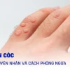 Vì sao bị mụn cóc và cách điều trị hiệu quả