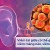 Viêm tai giữa: Nguyên nhân và cách điều trị hiệu quả cho mọi lứa tuổi