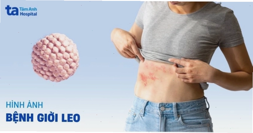 3 hình ảnh bị giời leo qua từng giai đoạn phát triển bệnh cụ thể