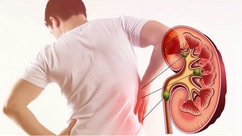 Ăn cà chua có thể gây sỏi thận ở người nhạy cảm