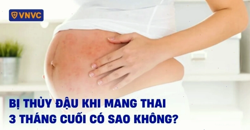 Bị thủy đậu khi mang thai 3 tháng cuối