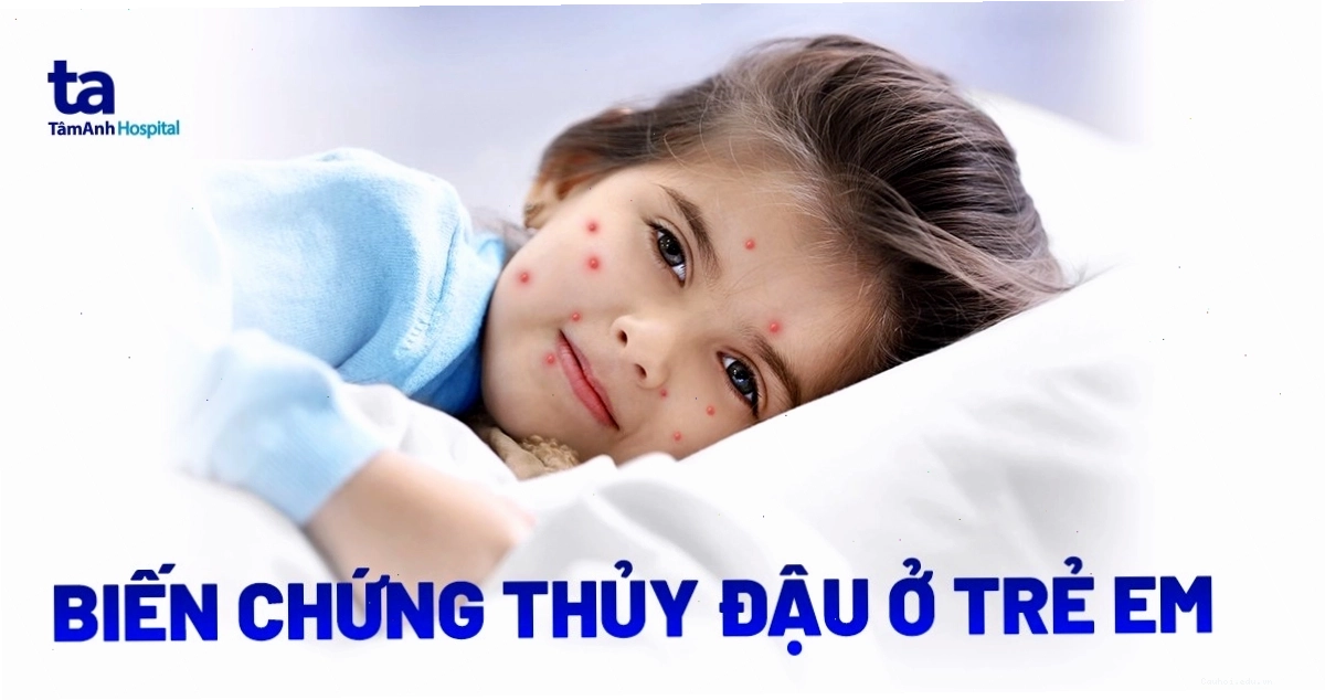 Biến chứng thủy đậu ở trẻ em