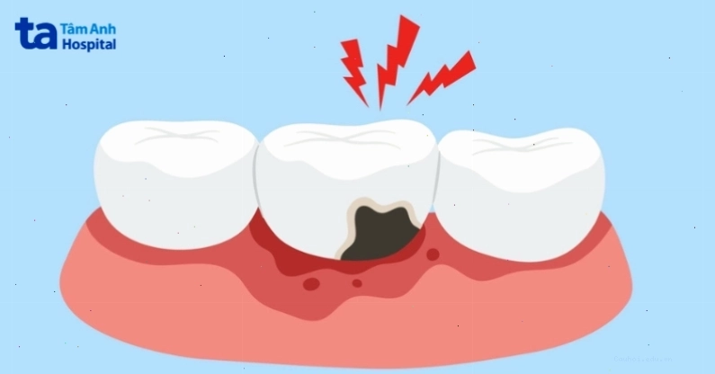 Biểu đồ thể hiện các cấp độ sâu răng, trong đó có sâu răng độ 3