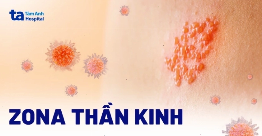 Biểu hiện bệnh zona thần kinh với các nốt phát ban và bọng nước