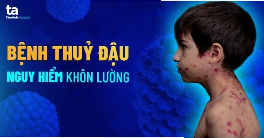 Biểu hiện của bệnh thủy đậu trên da