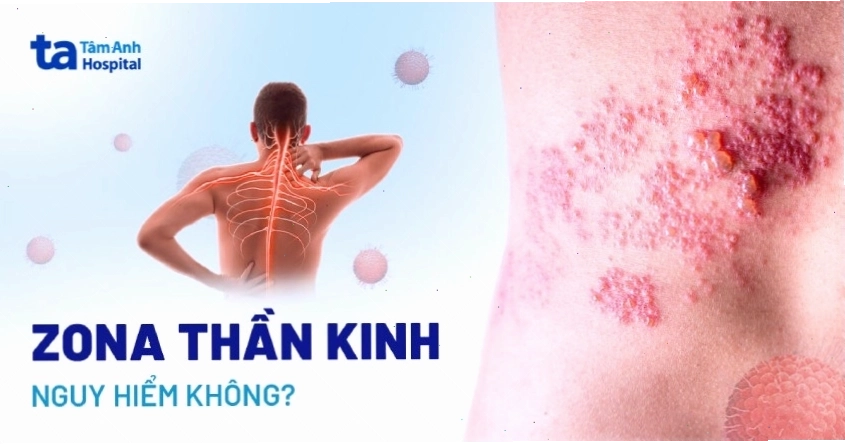 Các biến chứng nguy hiểm của bệnh zona thần kinh