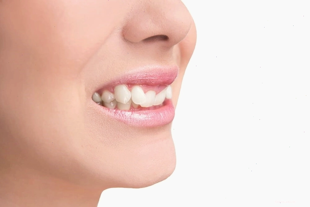 Các dạng răng hô vẩu thường gặp