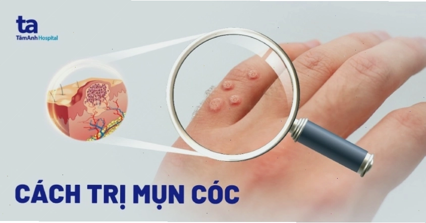 Các dụng cụ và thuốc điều trị mụn cóc