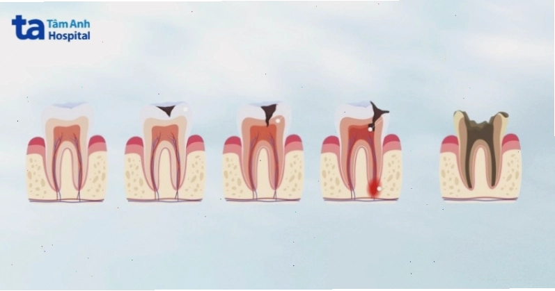 Các giai đoạn phát triển của bệnh sâu răng