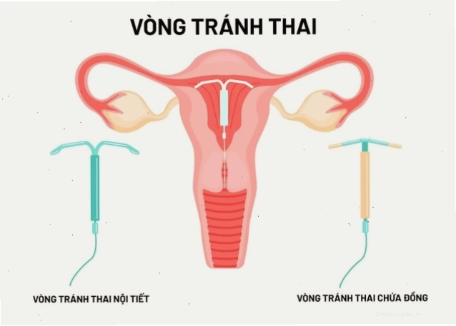 Các loại vòng tránh thai phổ biến trên thị trường hiện nay