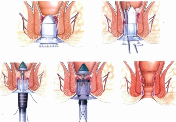 Các phương pháp điều trị bệnh trĩ phổ biến hiện nay