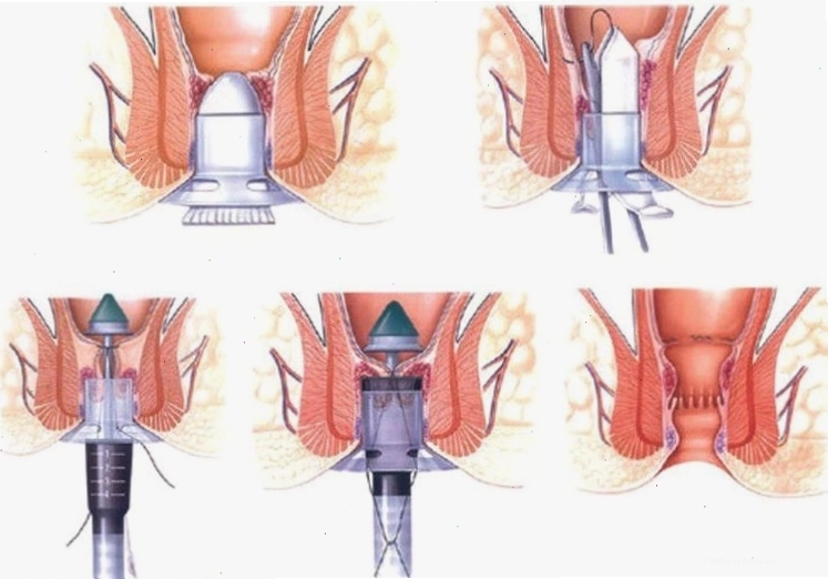 Các phương pháp phổ biến điều trị bệnh trĩ
