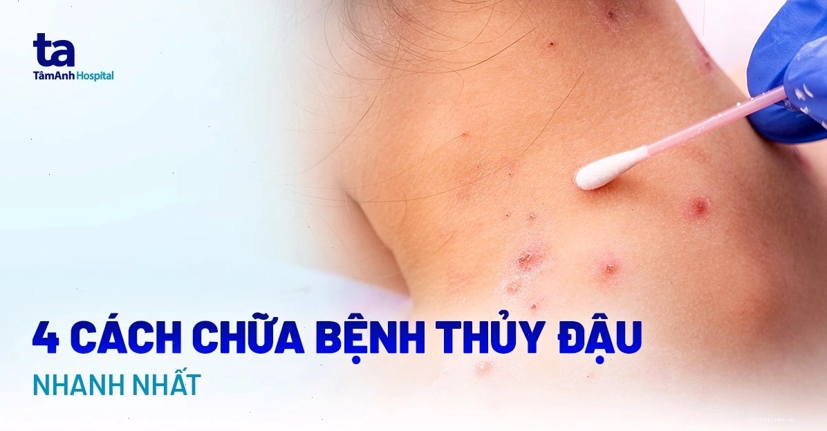 Cách chữa bệnh thủy đậu nhanh chóng tại nhà