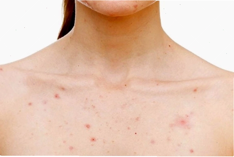 Cận cảnh tình trạng viêm nang lông ở chân
