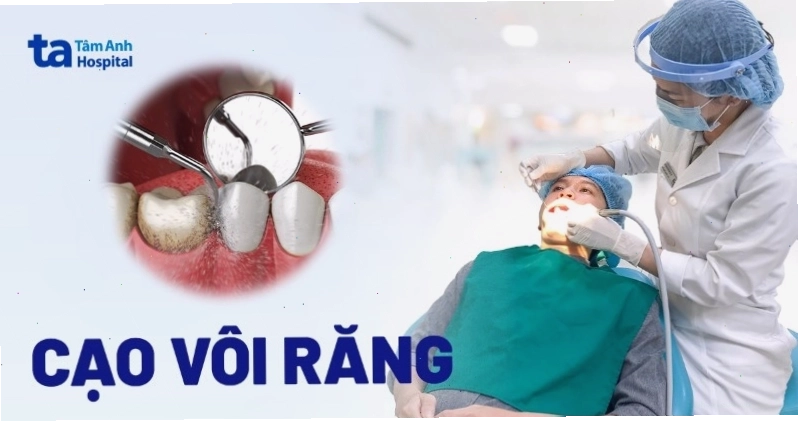 Cạo vôi răng là gì và những lưu ý