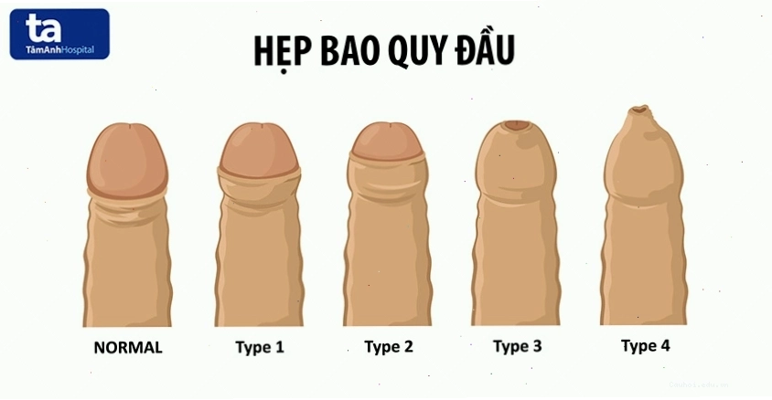 Chẩn đoán hẹp bao quy đầu