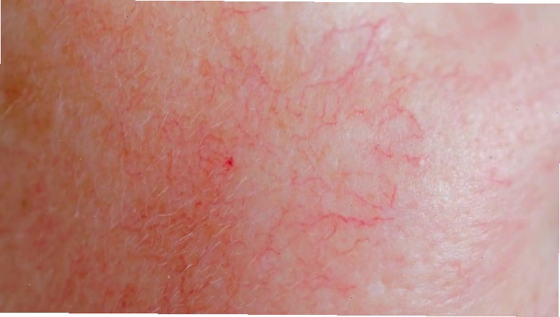 Corticoid có thể gây ra tình trạng giãn mạch máu và rạn da