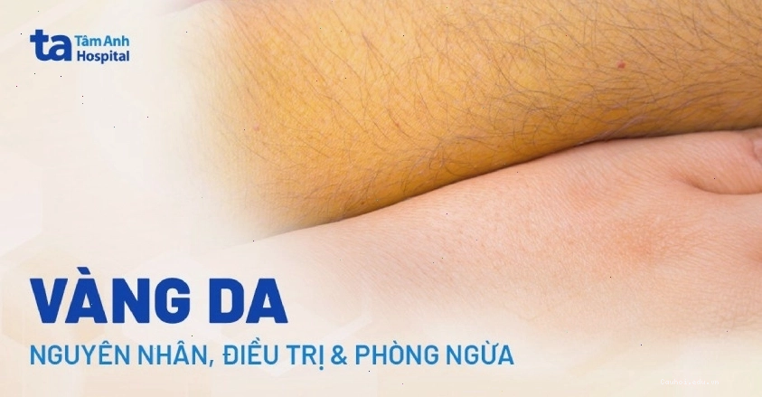 Da bị vàng là dấu hiệu cảnh báo vấn đề sức khỏe