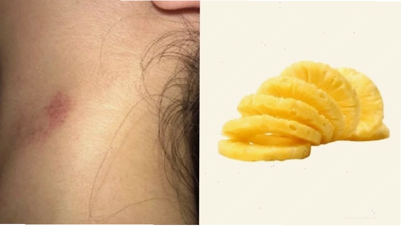 Đặt lát dứa lên vết hickey để làm mờ vết bầm