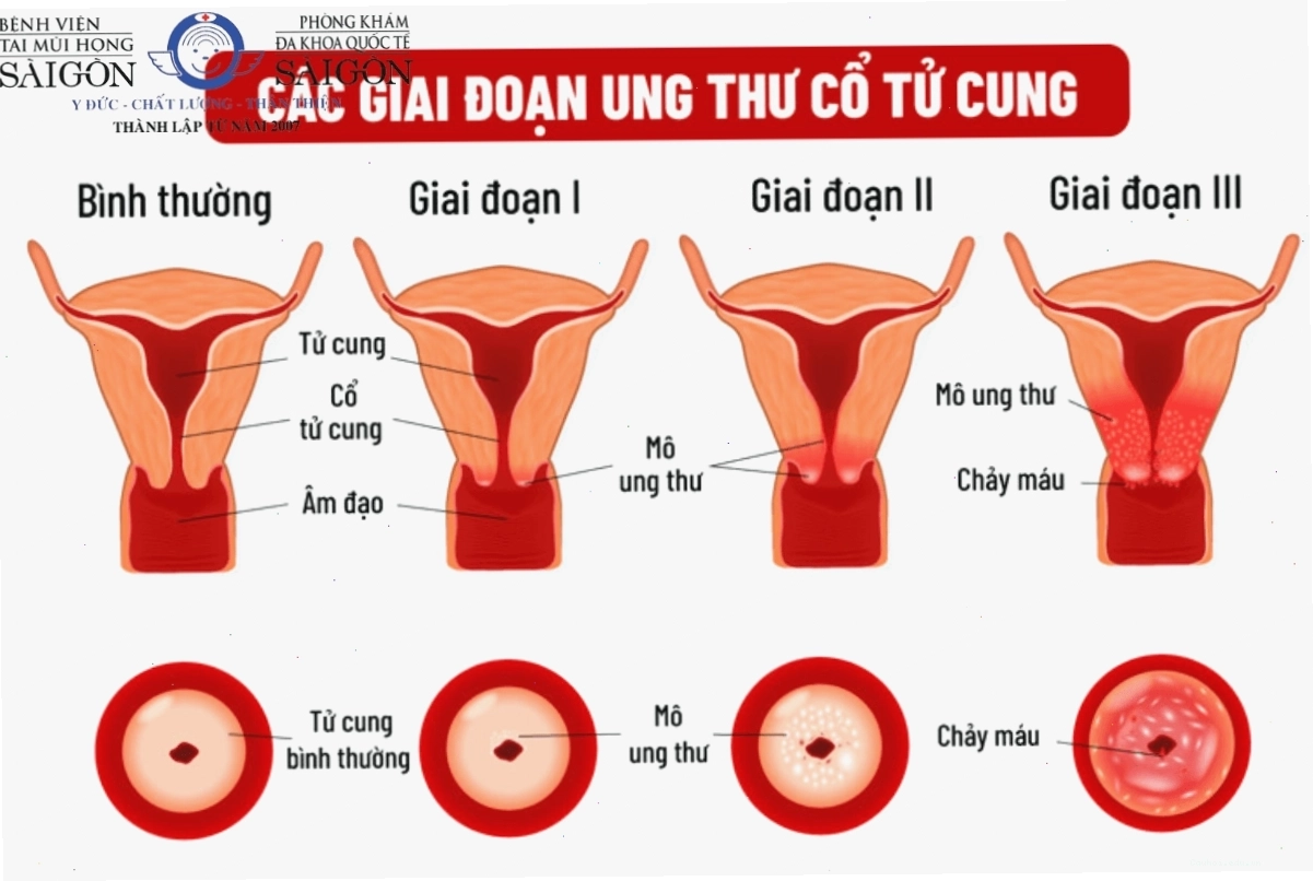Đau bụng dưới vùng quanh rốn khi tới kỳ có thể là dấu hiệu bệnh lý