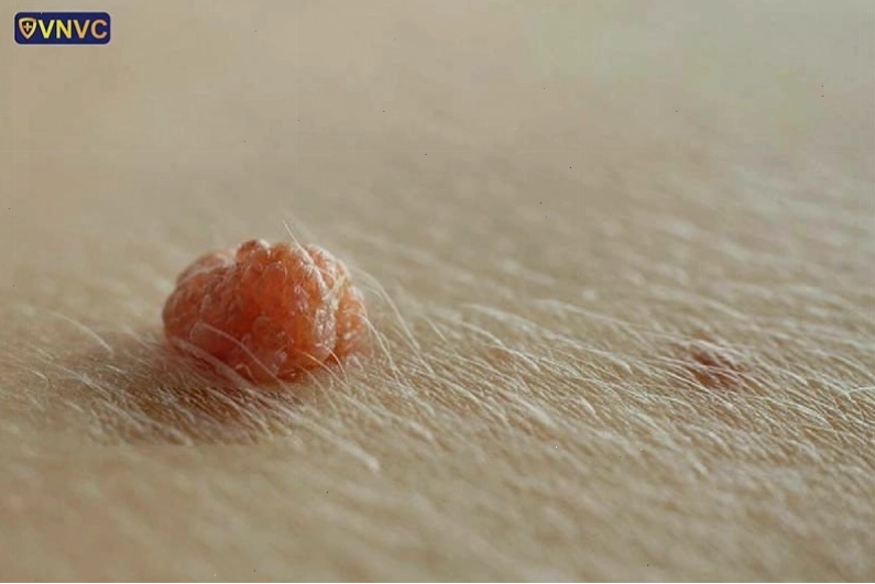 Dấu hiệu sùi mào gà ở nữ giới
