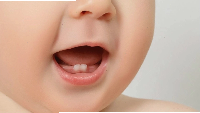 Dấu hiệu trẻ sốt mọc răng với nướu sưng đỏ