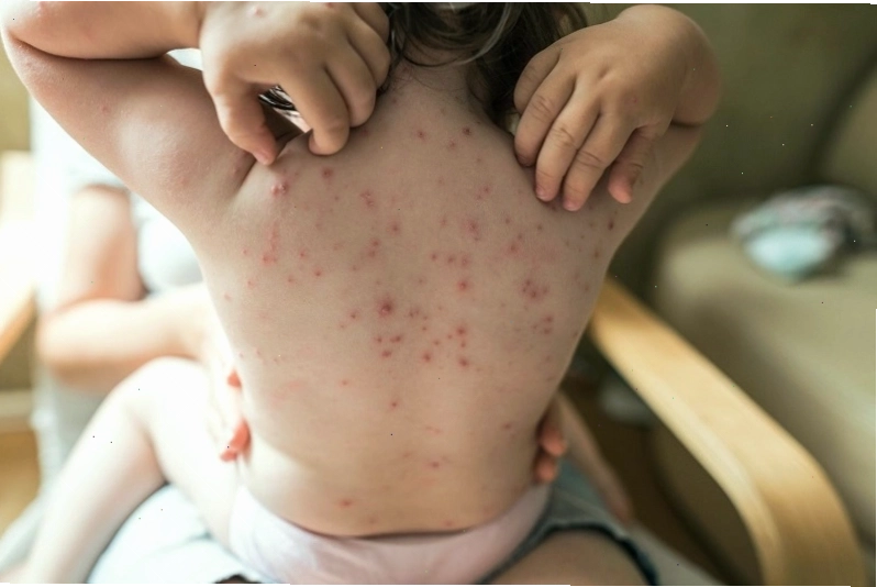 Gãi nốt ngứa không chỉ khiến lây lan mà còn có thể gây sẹo
