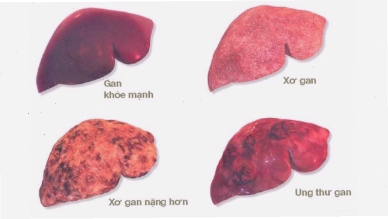 Gan bị tổn thương nghiêm trọng do lạm dụng rượu bia