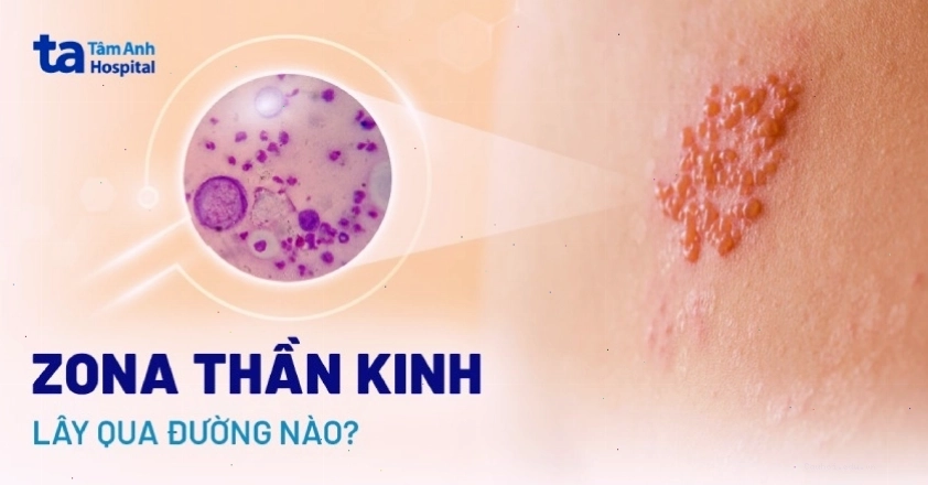 Giải đáp thắc mắc zona thần kinh có lây không