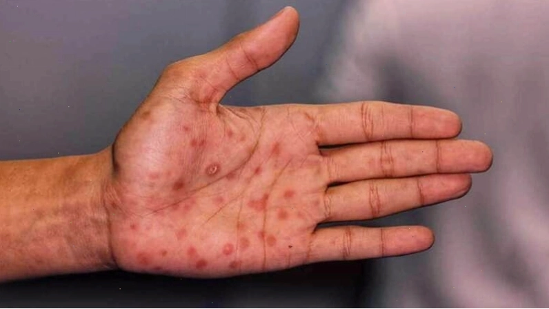 Giang mai là một bệnh lây nhiễm tình dục có thể biểu hiện ở lưỡi