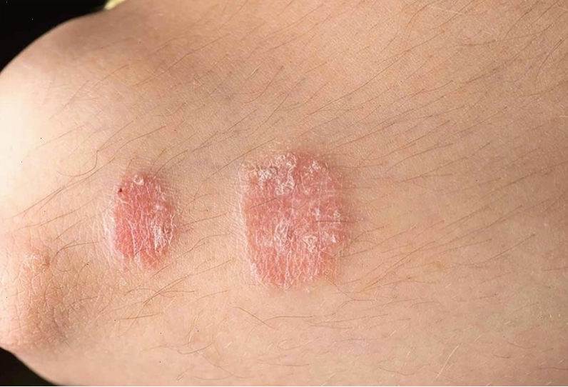 Giữ vệ sinh sạch sẽ là yếu tố quan trọng trong điều trị hắc lào