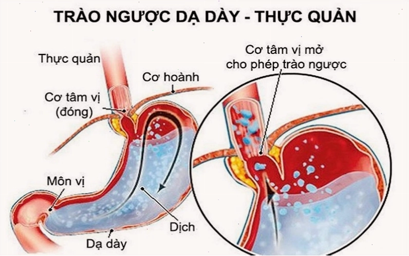 Hình ảnh minh họa bất thường ở cơ hoành và cơ thắt thực quản dưới gây trào ngược dạ dày