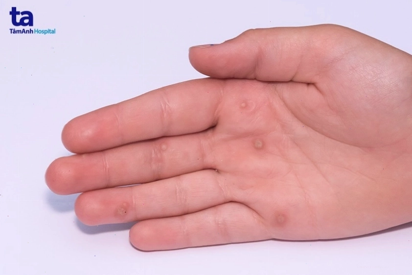 Hình ảnh minh họa các biện pháp phòng ngừa mụn cóc