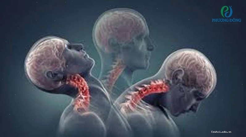 Hình ảnh minh họa gãy xương cổ