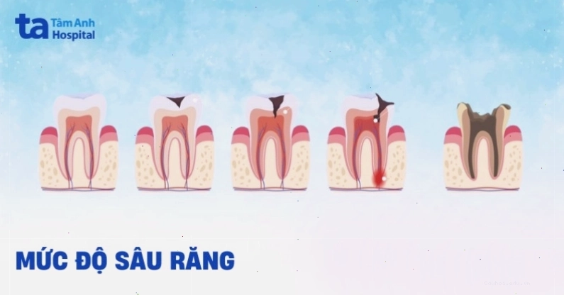Hình ảnh minh họa mức độ sâu răng, nhấn mạnh giai đoạn răng sâu độ 3