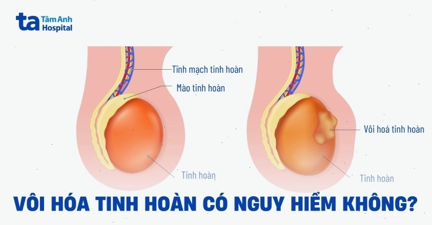 Hình ảnh minh họa nốt lẹo mắt với nhiều mủ