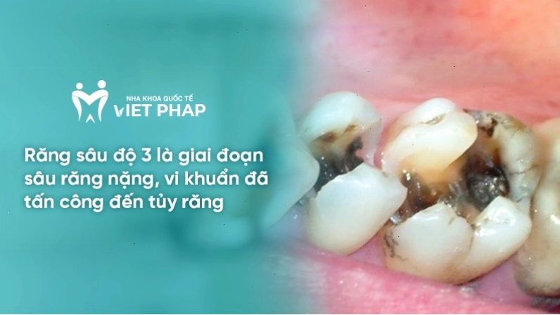 Hình ảnh minh họa răng sâu độ 3 với lỗ sâu lớn tấn công tới tủy