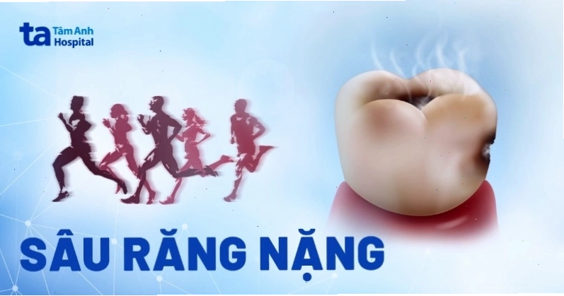 Hình ảnh minh họa sâu răng nặng và các phương pháp điều trị tương ứng