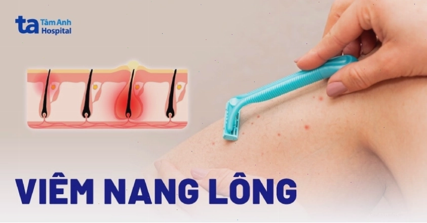 Hình ảnh minh họa tình trạng viêm nang lông trên da
